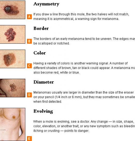 How Can You Tell If You Have Skin Cancer